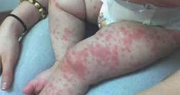 Вирус Коксаки добрался до Кривого Рога: госпитализированы 14 человек